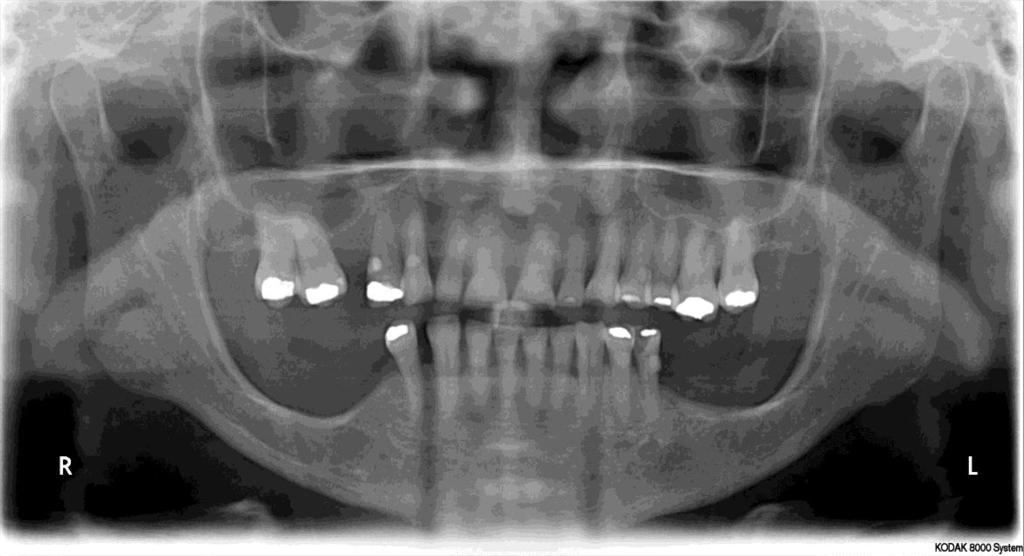 35 Q3 = cortical mandibular classificada como C3, de acordo com o ICM e IPM < 3mm (Figura 4.15); Figura 4.