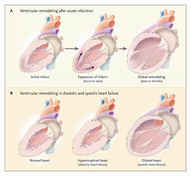Remodelação ventricular após IAM (A) e na IC Diastolica e