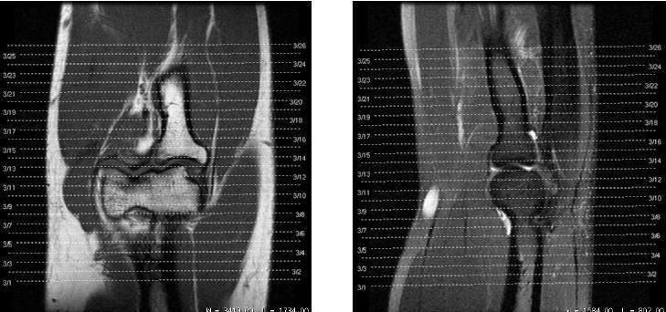 Cotovelo Coronal T1/DP Coronal T2 Fat (Fotografar) Sagital T2 Fat (Fotografar) Axial T2 Fat (Fotografar) Axial T1(Fotografar) Contraste (se necessário) Coronal T1 Fat Axial T1 Fat