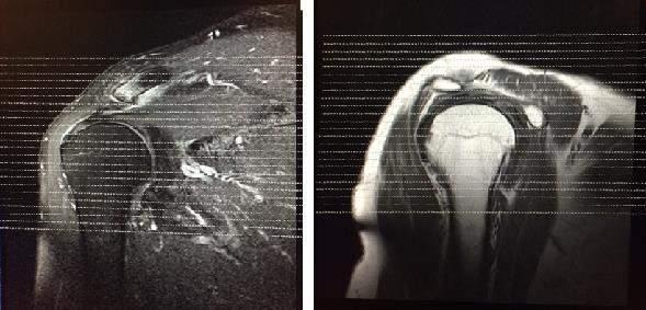 2 / 77 Músculo Esquelético MEMBRO SUPERIOR Ombro/Escápula Coronal T1/DP (Fotografar) Coronal T2 Fat (Fotografar) Sagital T1/DP Sagital T2 Fat (Fotografar) Axial T2 Fat (Fotografar)