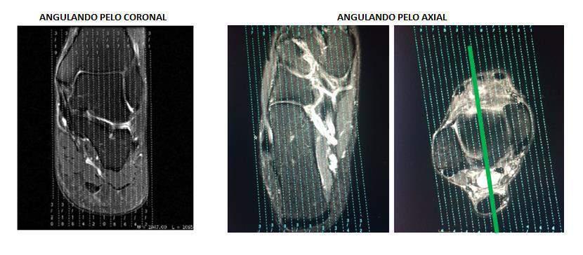 - Sagital: Programar a sequência angulada perpendicularmente à articulação tibiotalar no