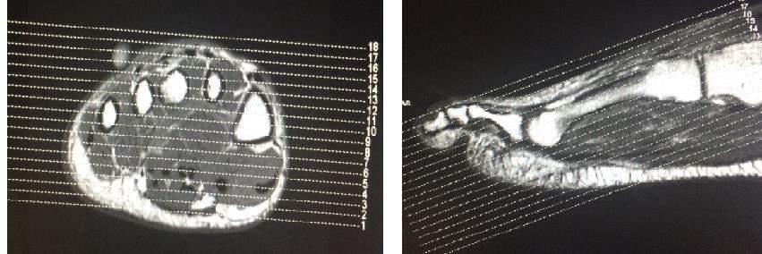 Pé Sagital T2 Fat Axial T2 Fat (Fotografar) Axial T1/DP (Fotografar) Coronal T2 Fat (Fotografar) Coronal T1/DP(Fotografar) Contraste (se necessário) Coronal T1