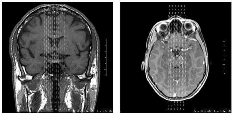 Hipófise Sagital T1 Coronal T1(Fotografar) Coronal T2 (Fotografar) Coronal Dinâmico Contraste Coronal T1Fat (Fotografar) Sagital T1Fat