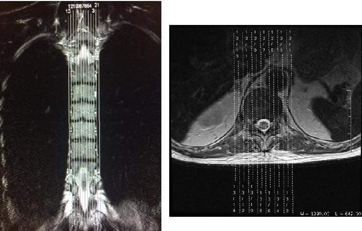 Coluna Torácica Contador vértebras (FOV grande pegando cervical/torácica) Sagital T2 (Fotografar) Sagital T1(Fotografar) Sagital T2 Fat Axial T2 (Fotografar) Contraste (se necessário) Sagital T1 Fat