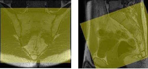 Sacro cóccix Sagital T1 Sagital T2 Fat (Fotografar) Axial T2 (Fotografar) Axial T1 Coronal T2 Fat (Fotografar) Contraste (se necessário) Sagital T1Fat (Fotografar) Axial T1 Fat 61 / 77