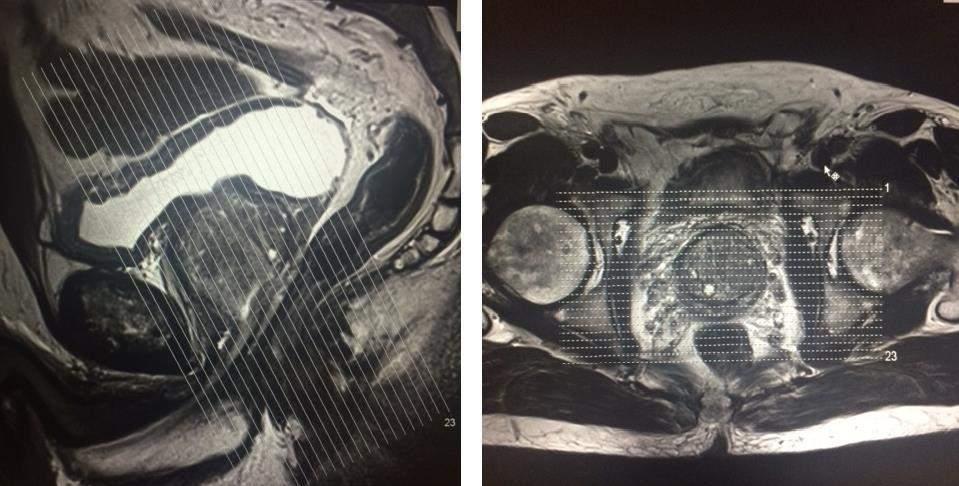 A angulação seguindo orientação e anatomia da próstata.