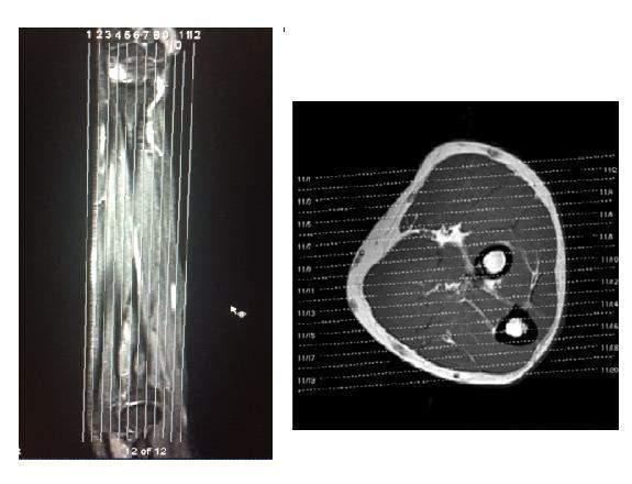 - Coronal: Programar a sequência angulada paralelamente à ulna e rádio no plano