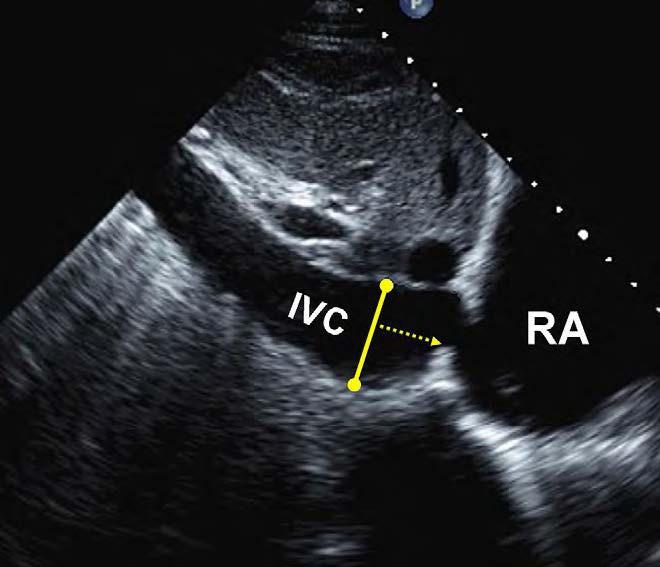 A maior dimensão do átrio direito está representada pela linha verde a partir do centro do TA até a parede superior do AD, e a dimensão menor do AD é repre- sentada pela linha