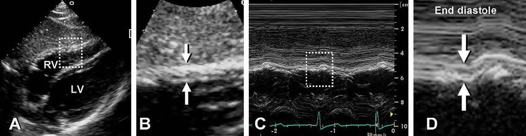 Figura 5 - Medida da espessura diastólica final da parede ventricular direita. (A) Imagens bidimensionais da parede ventricular direita a partir da janela subcostal.