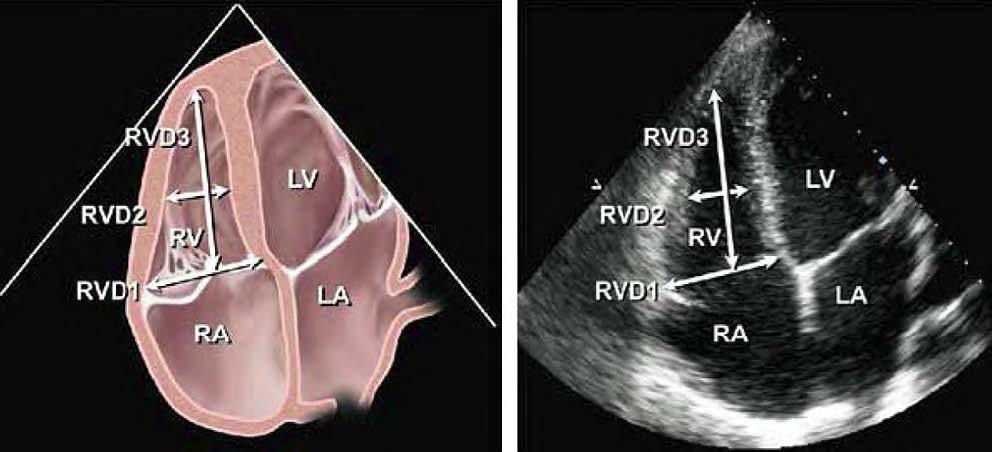 Figura 7 - Diagrama esquemático (esquerda) e as imagens ecocardiográficas correspondentes na janela apical 4-câmaras (direita) demonstrando as medidas menores do VD (RV) ao nível basal (RVD1), médio