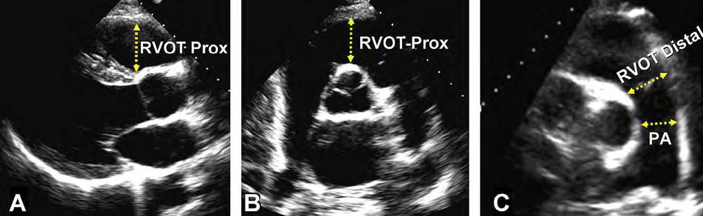 A parede livre do VD (RV) é melhor visibilizada neste plano, também, facilitando as medidas da variação fracional da área. Reproduzido de J Am Soc Echocardiogr.