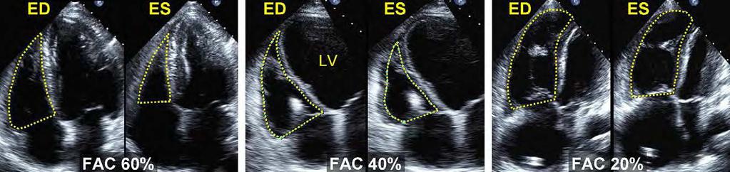 Figura 9 - Exemplos de cálculos da variação fracional da área (FAC). A FAC percentual = 100 x Área diastólica final (Area ED) Área sistólica final (Area ES)/Área diastólica final.