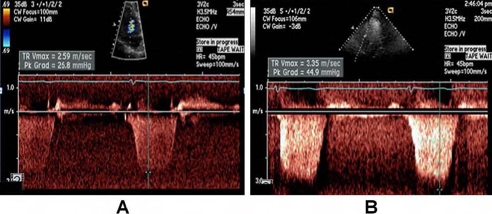 A PSAP é calculada como a soma da pressão estimada do AD (PAD) e o pico do gradiente pressórico entre o AD e VD, que corresponde ao pico da velocidade da IT, estimada pela equação de Bernoulli