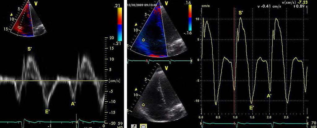 Figura 18 - Doppler tecidual do anel valvar tricúspide em paciente com função sistólica normal do VD: (esquerda) pulsátil e (direita) análise offline codificada em cores.