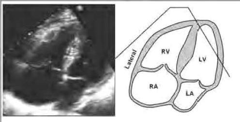 Utilizado para avaliação do septo interatrial e possíveis shunts interatriais (particularmente fluxo de forame oval patente posterior a raiz da aorta).