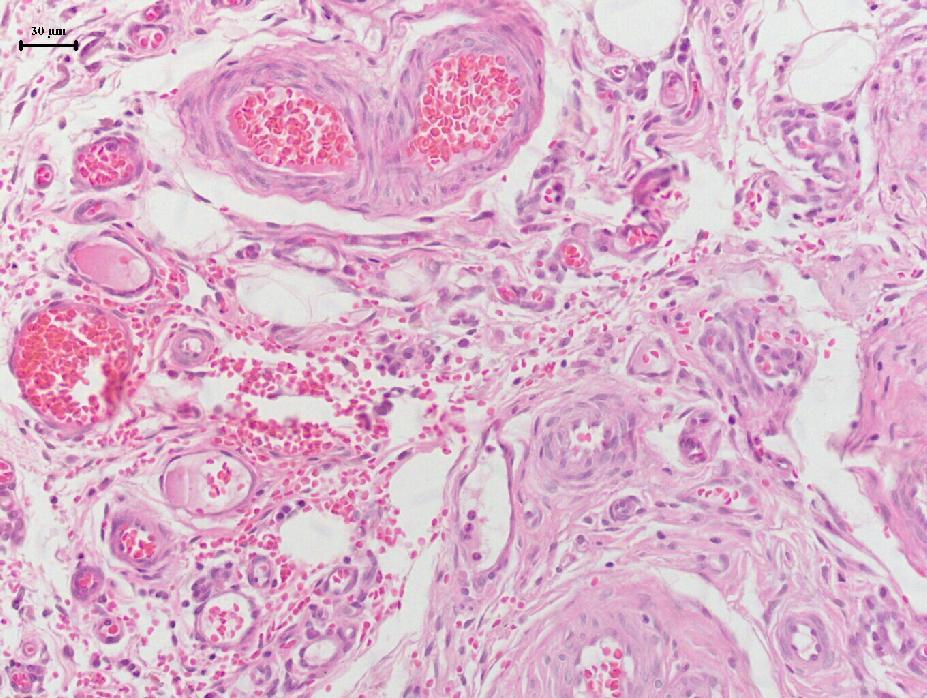 Neovascularização Tecido de granulação Células inflamatorias OD Abraçadeira (+) 27,27% (++) 18,18% (+) 63, 63% (++)18,1% (+) MN9,0% (++) PMN 9,9% (++)MN9,09% OE Náilon (+) 63,63% (++) 9,09% (+) 9,09%