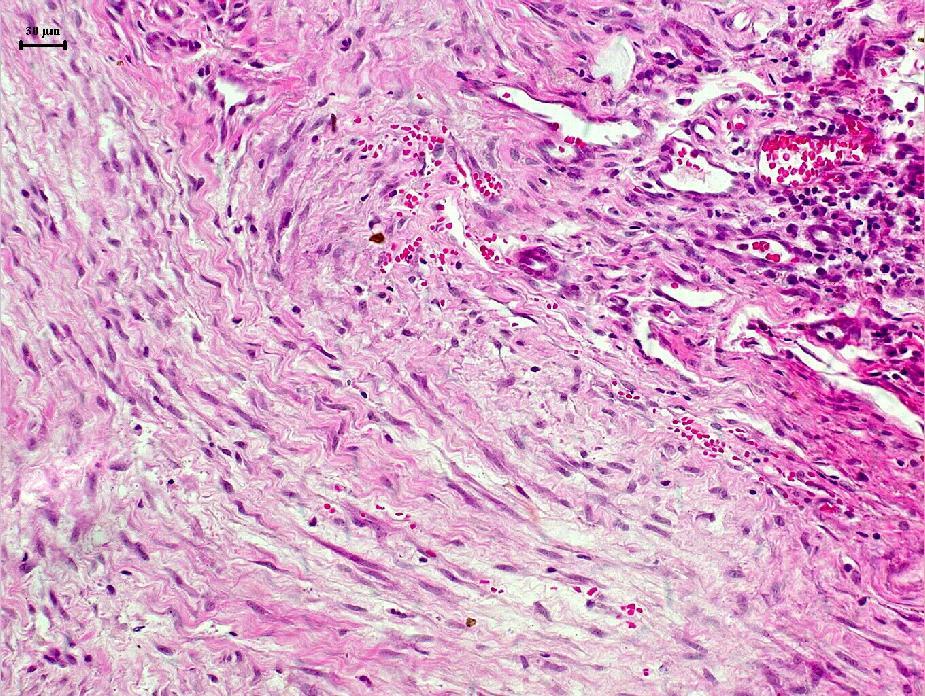 (A) Proliferação de tecido conjuntivo fibroso (denso), HE, Barra: 30µm. (B) Neoformação vascular (seta branca), HE, Barra: 20 µm.