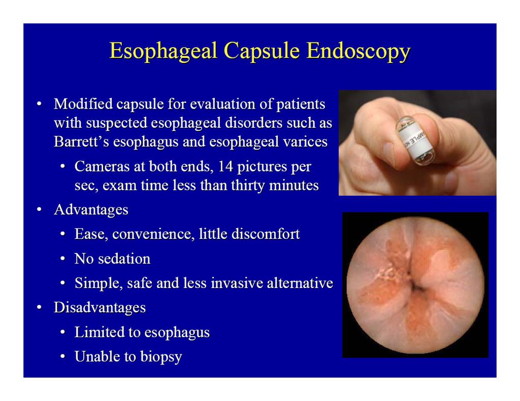 Detecção do esófago de Barrett Cápsula endoscópica