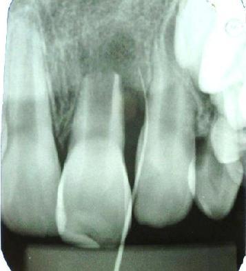 A maioria dos casos relatados pela literatura a- presentaram uma diminuição no espaço do canal radicular, com espessamento das paredes dentinárias, contínuo desenvolvimento radicular e diminuição do