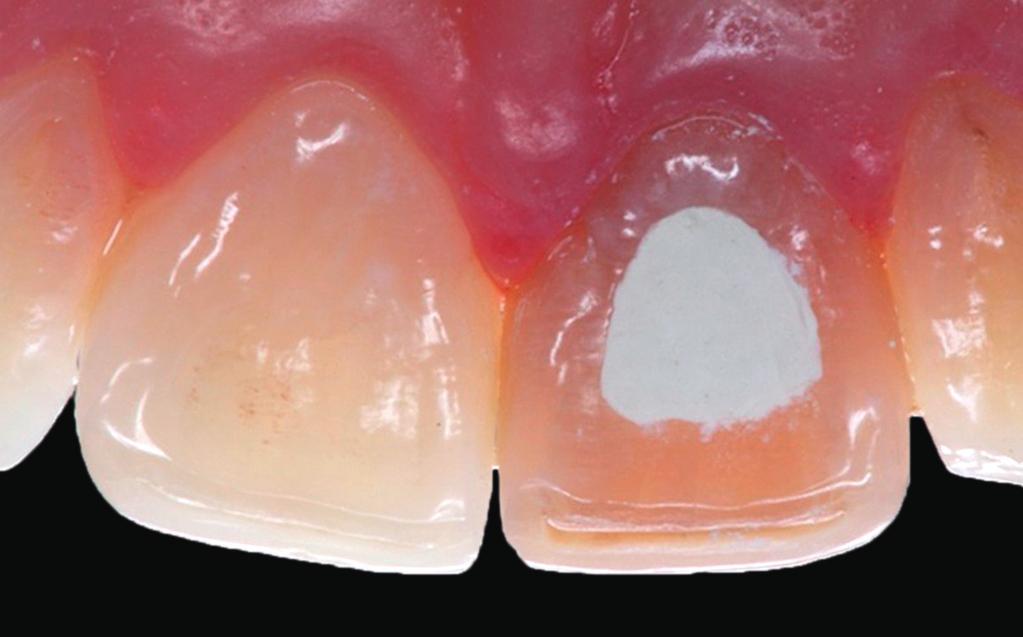 Longevidade de clareamento em dente não vital com associação de técnicas: relato de caso de presa química (Vitro Fil, DFL) (Fig. 3).
