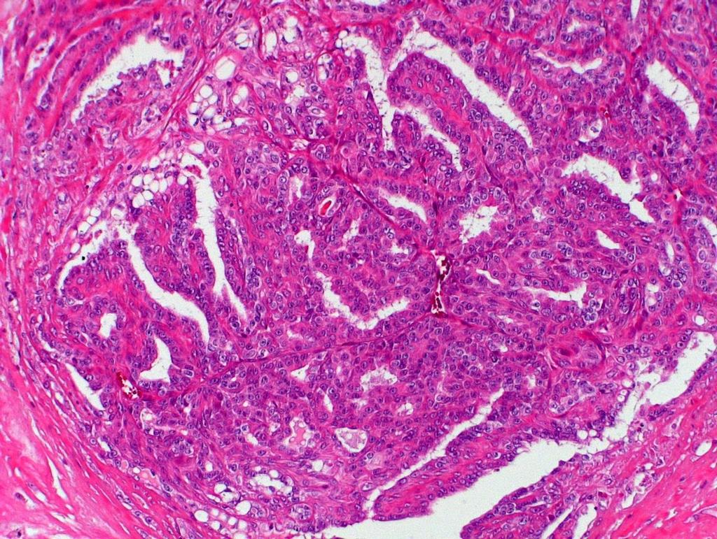 23 FIGURA 1 Fotomicrografia de carcinoma mamário túbulo-papilífero em gata.