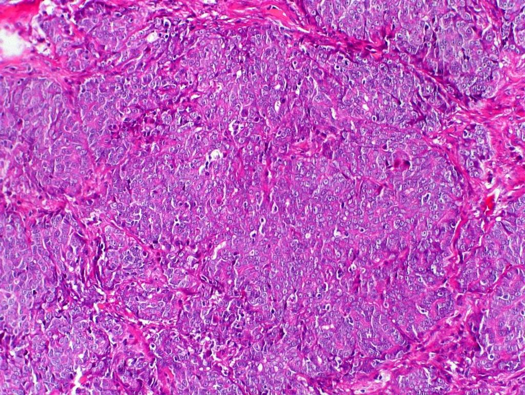 Coloração de HE em objetiva de 20x FIGURA 2 - Fotomicrografia de carcinoma mamário sólido