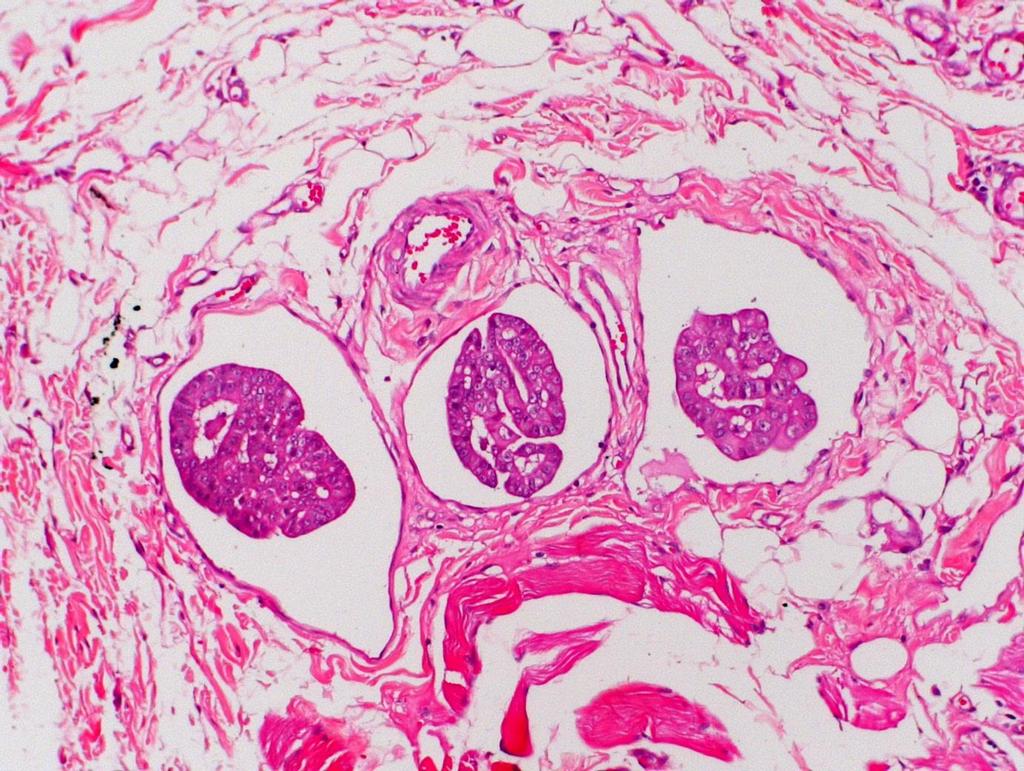 26 FIGURA 4 - Fotomicrografia de carcinoma mamário túbulo-papilífero em gata.