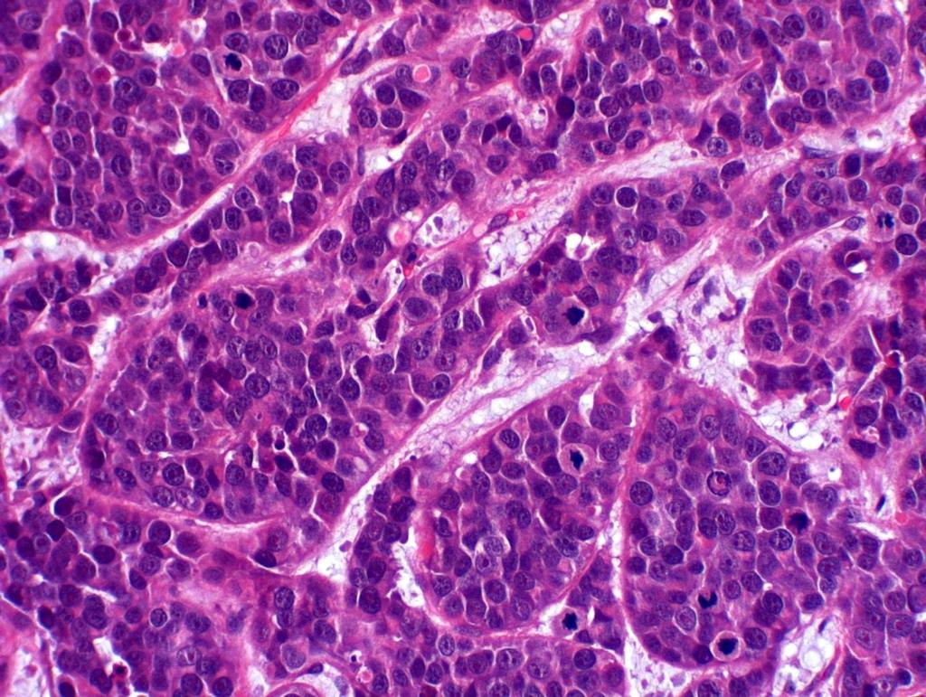HE, objetiva de 20x FIGURA 5 - Fotomicrografia de carcinoma mamário sólido em gata.
