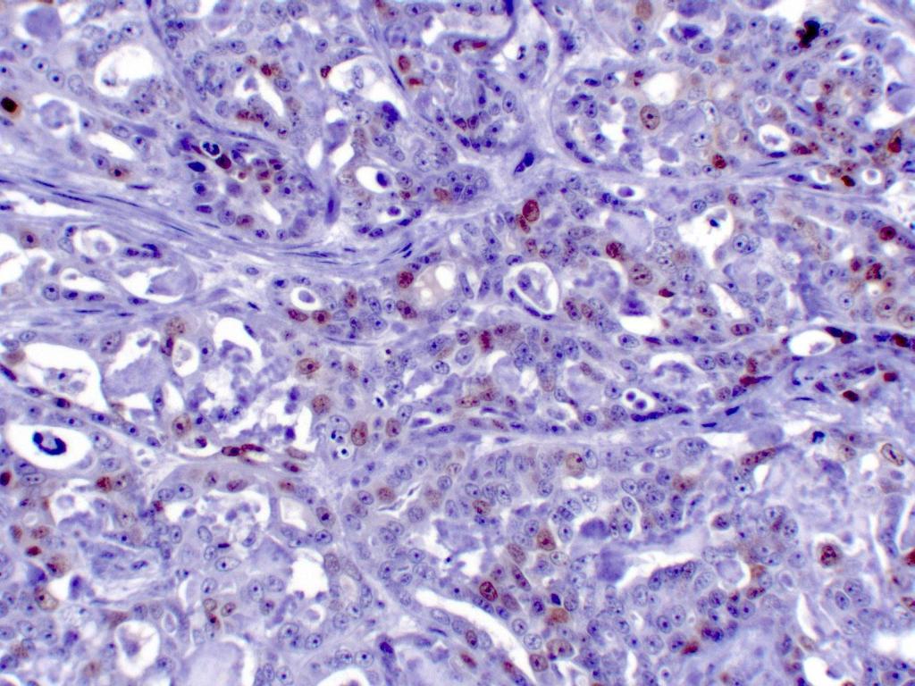 29 TABELA 11 - Valor Médio do IP apresentado pelas gatas com neoplasia maligna mamária segundo tipo histopatológico Tipo N IP Túbulo-papilífero 13 32,54% Sólido 14 38,26% Cribriforme 4 38,00% 7, 8 e