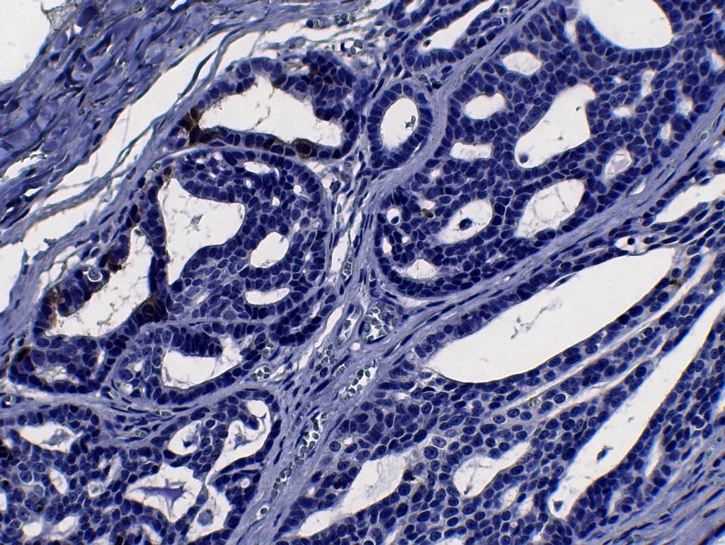 33 FIGURA 11 Fotomicrografia de carcinoma túbulo-papilífero em gata, marcação de Caspase 3 com