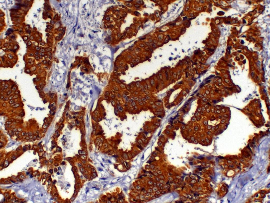 35 FIGURA 13 - Fotomicrografia de Carcinoma túbulo-papilífero em gata.
