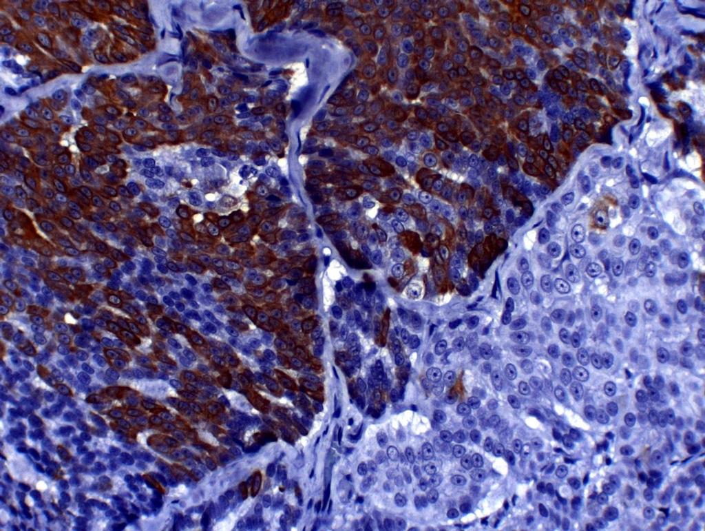 com Hematoxilina de Harris BAR, objetiva 40x. FIGURA 14 - Fotomicrografia de carcinoma sólido em gata.