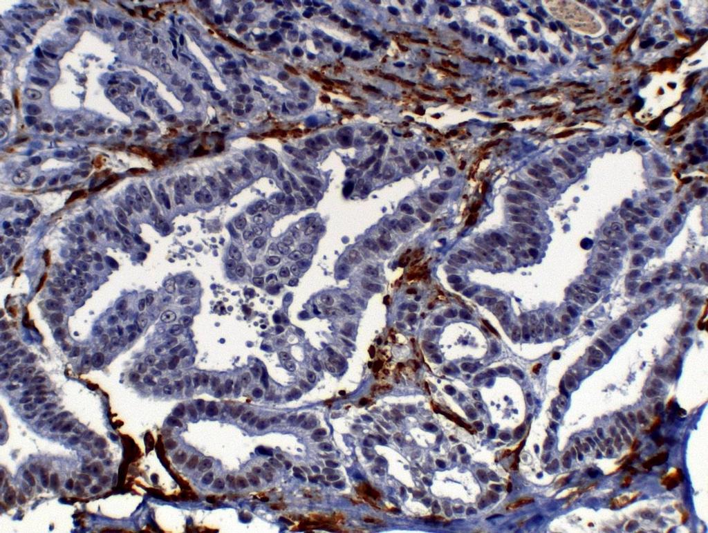 37 FIGURA 15 - Fotomicrografia de carcinoma túbulo-papilífero em gata.