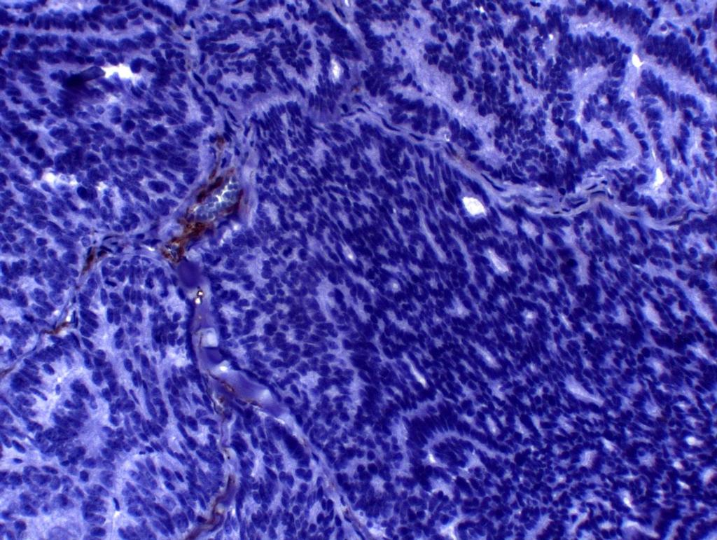 de Harris BAR, objetiva 40x. FIGURA 16 - Fotomicrografia de carcinoma sólido em gata.