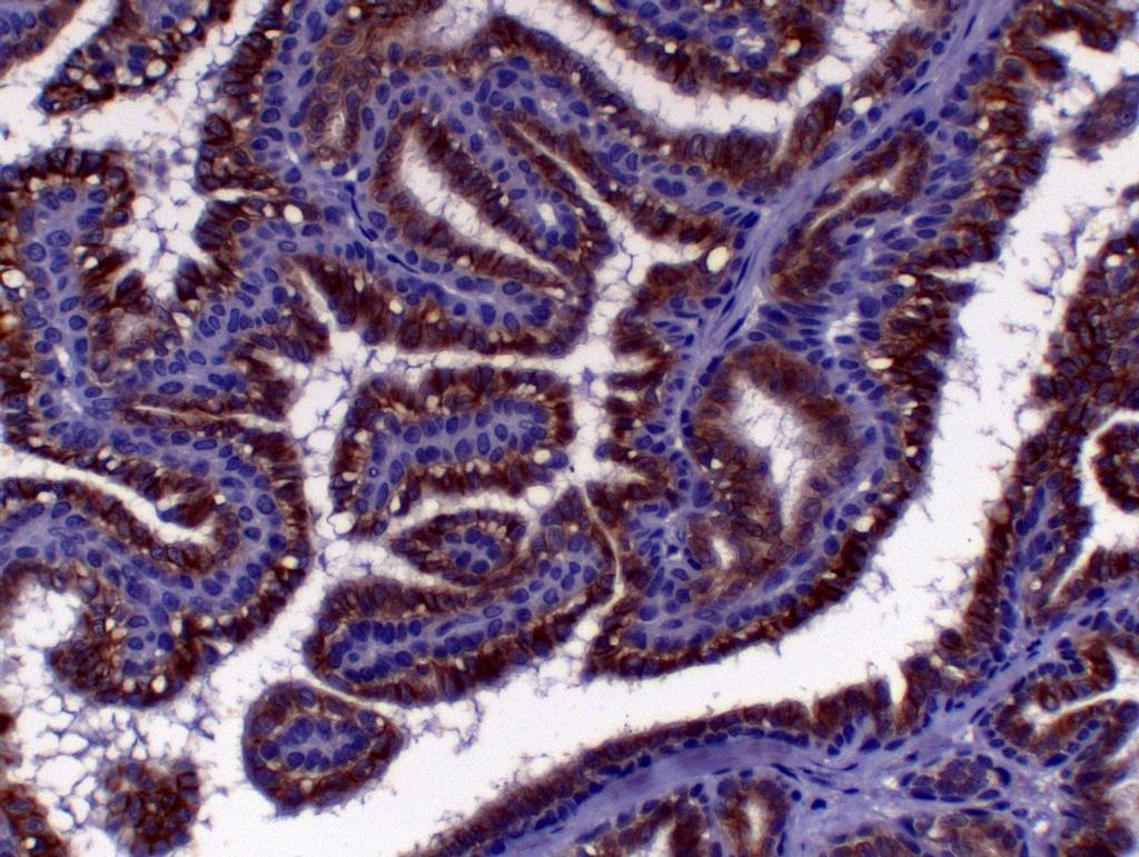 42 FIGURA 19 - Fotomicrografia de carcinoma túbulo-papilífero em gata.