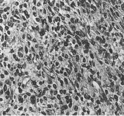 A B C D FC E Figura 1. Fotomicrografias de fibrossarcoma da rata pinealectomizada do grupo II.