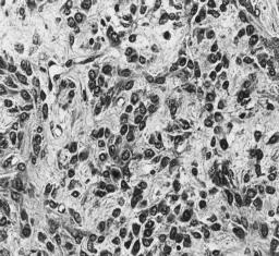 pleomorfismo (H.E.; ±428x). (D) Células fusiformes e estreladas, entremeadas com fibras colágenas (FC) (H.E.; ±428x). (E) Nódulo cartilaginoso (asterisco), localizado ao lado da massa neoplásica (H.