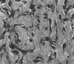 As células neoplásicas infiltravam-se no tecido conjuntivo interlobular (Fig. 2B).