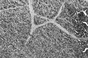 A B Figura 2. Fotomicrografias de adenocarcinoma da rata pinealectomizada do grupo III. (A) Células neoplásicas arranjadas sob a forma de ácinos e lóbulos (H.E.; ±107x).