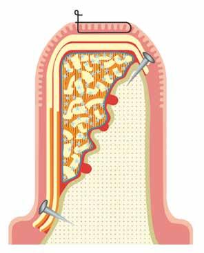 Departments of Periodontology Diagrama de Fluxo Oito Step by step approach for the preparation of L-PRF block.