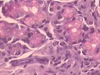 quantidade; proliferação de linfócitos na lâmina própria; deposição de proteínas no interstício e aumento de volume das glândulas de Brunner.