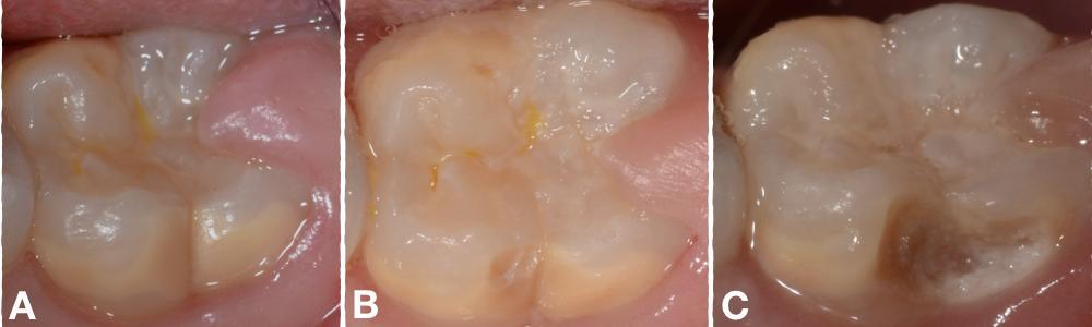 Figura 4. Progressão dos defeitos em dente afetado pela MIH.