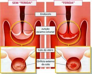 COLO UTERINO Endocérvice: canal cervical, que comunica a cavidade uterina com a vagina.