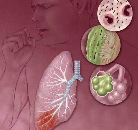 Pneumonia Comunidade Patógenos mais comuns: Ambulatorial (quadros leves) Streptococcus pneumoniae Mycoplasma pneumoniae