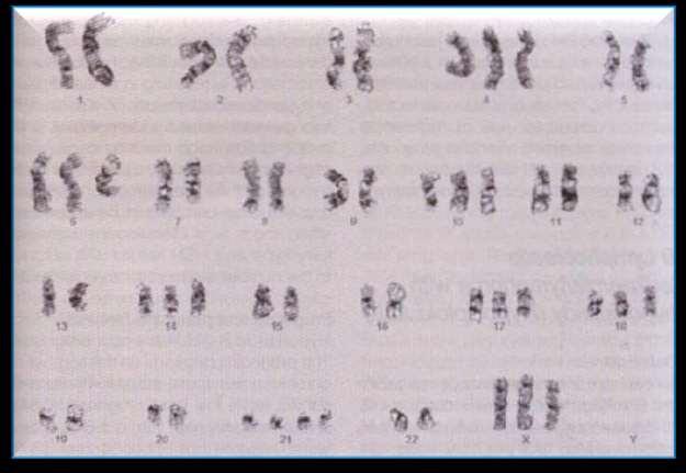 30 Figura 03-Hiperdiplodia em pacientes com Leucemia Linfoblástica Aguda. Cariótipo banda G mostrando 55 cromossomos, com trissomia do 4, 6, 10,14, 17,18 e X e tetrassomia do 21.