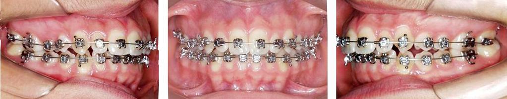 Figura 6 Tomografia computadorizada evidenciando a necessidade de posicionamento vestibular e equilíbrio entre as corticais do dente 15.