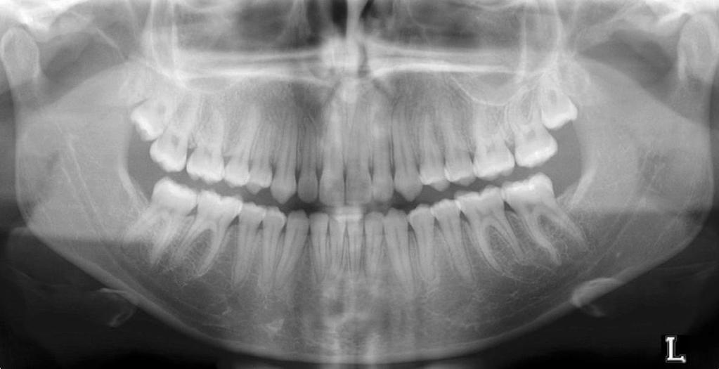 obtivemos a correção da maloclusão diagnosticada no início do tratamento