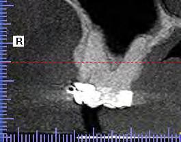 do septo utilizando o próprio guia radiográfico e uma régua milimetrada.