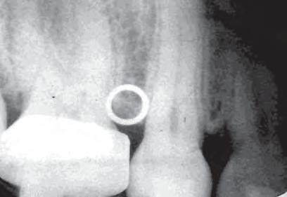 A inserção dos POAF foi efetuada pelo mesmo profissional que realizou a radiografia de diagnóstico