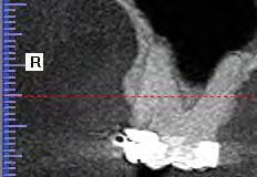 inclinação do dispositivo ortodôntico na direção buco-lingual, evitando complicações clínicas em relação ao seio maxilar do paciente.